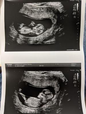 Photo of 2 sonograph prints showing a baby growing in Sakino's womb.